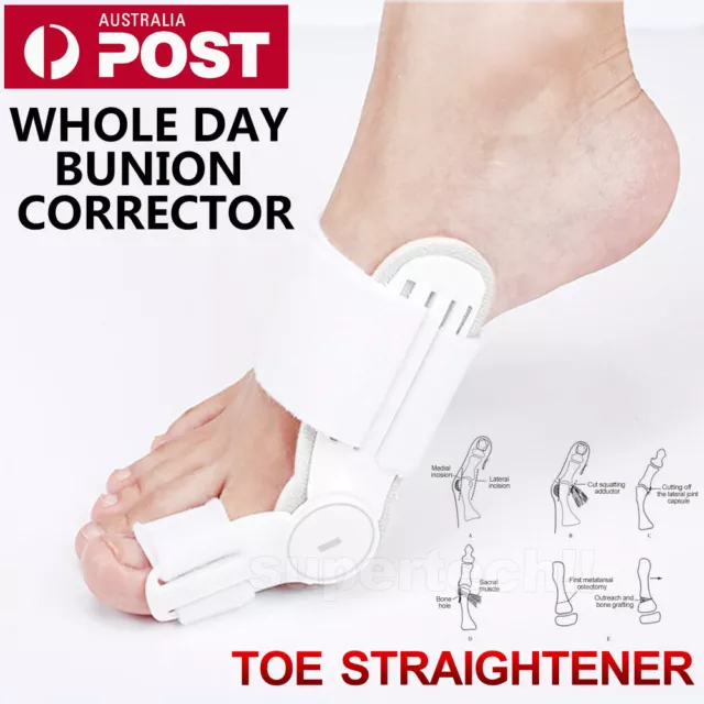 Toe Bunion Corrector Hammer Splint Straightener Orthopedic Brace Hallux Valgus