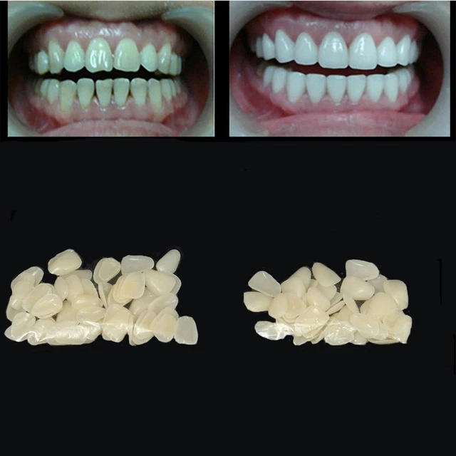Medical Veneers Porcelain Teeth Resin Teeth Dental Films Upper Anterior