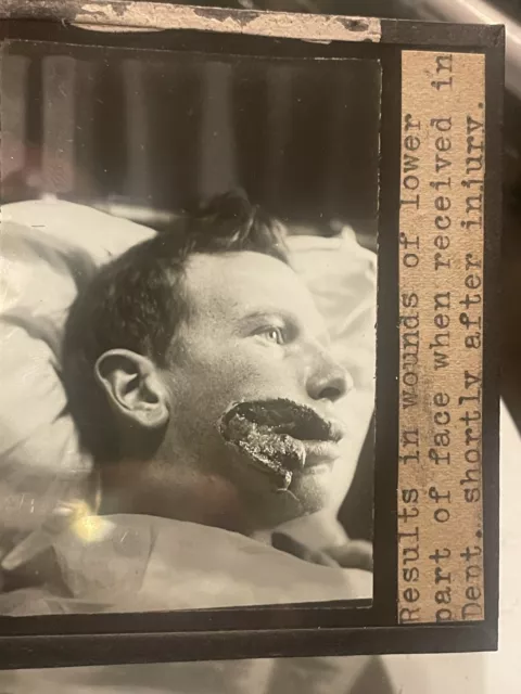 Antique Medical GLASS SLIDE Face Injury prior SURGERY Massive Damage   #11 c1916
