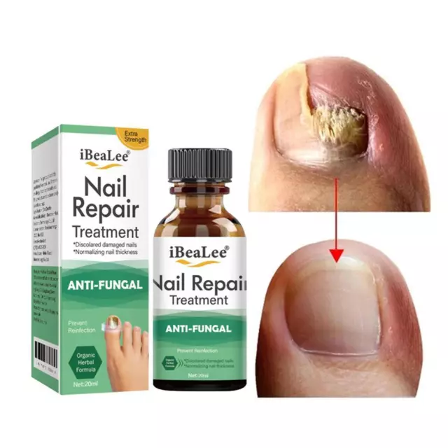 Nagelpilz Entfernung Creme Anti-Pilz Fuß Nägel Reparatur Pflege Salbe R8Q9