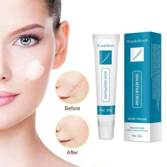 Marks Body Care Reduce Chirurgia Acne Migliore cura della pelle per cicatrici rimozione cicatrici crema