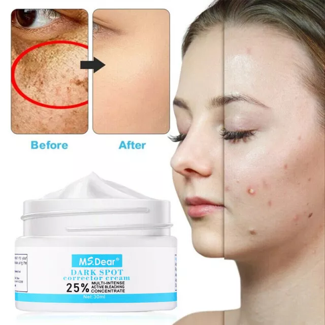 Crema sbiancante melasma forte rimozione lentiggini Speckle brufoli melano