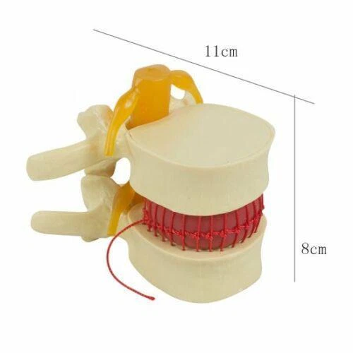 PVC Spine Model: Demonstrate Lumbar Disc Herniation in Medical Education