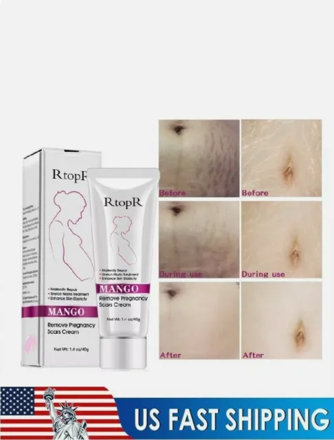 Get Rid of Stretch Marks and Scars with Rtopr Mango Cream - Safe and Effective