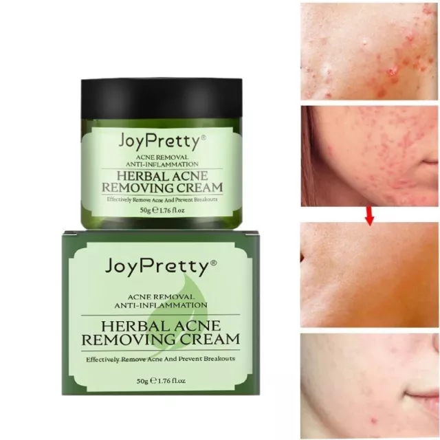 Acne Face Cream Herbal Pimple Scar Removal Shrink Pores Oil Control Moisturizing