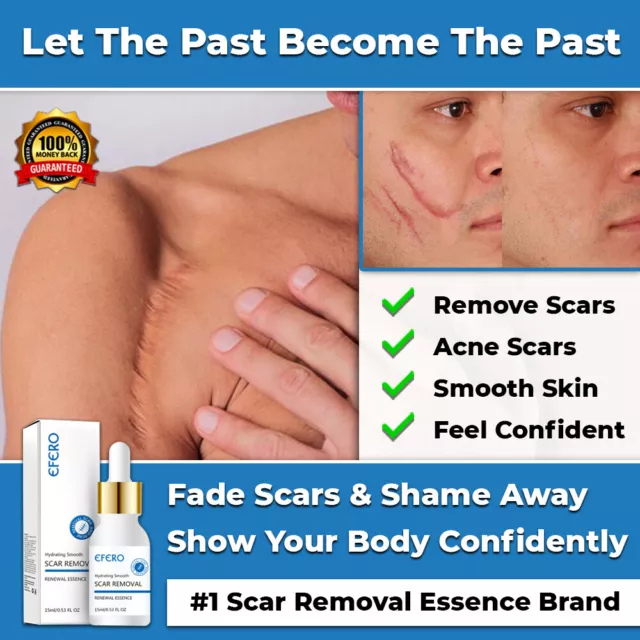 New Scar Removal Cream Safe Acne Scar Remover Natural Skin Repair Fade Scars