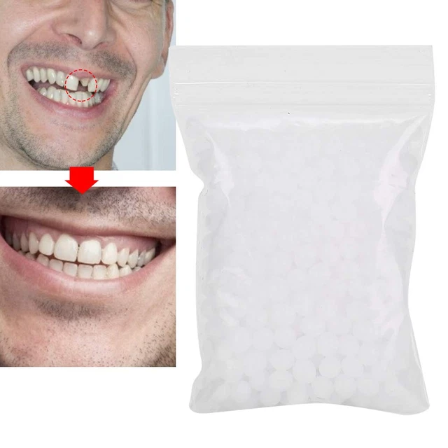 Protesi provvisoria otturazione dentale perline di riparazione temporanee mancanti