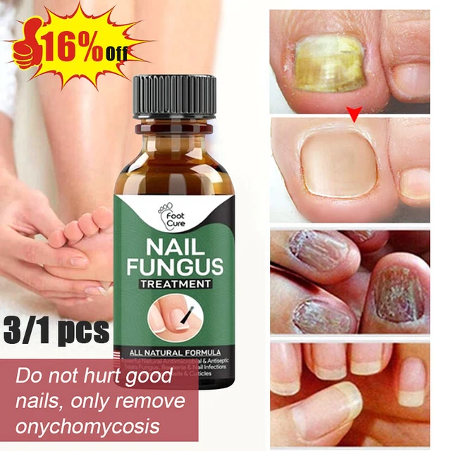 3/1 pz 30 ml fungo riparazione unghie essenza cura trattamento gel sbiancante -