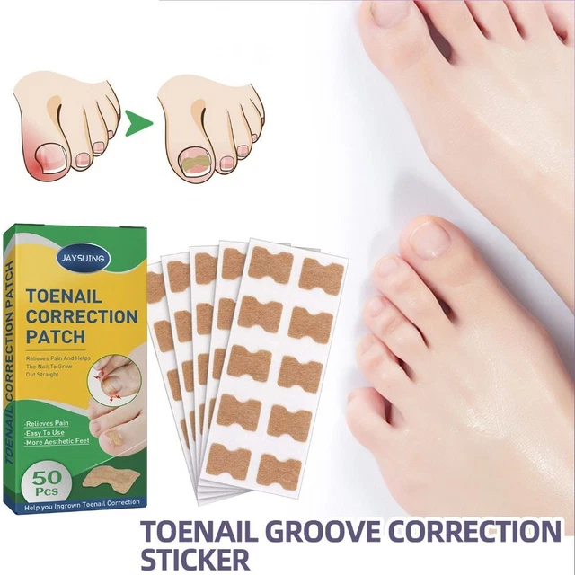 incarné Autocollants de correction des ongles Imperméable Patchs correcteurs