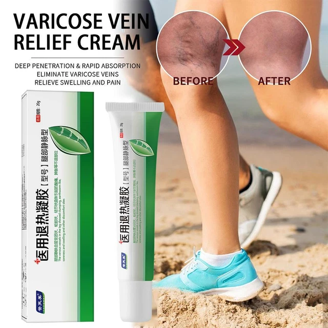 Effective Varicose Veins Relief Cream Relieve Vasculitis Phlebitis 20g~