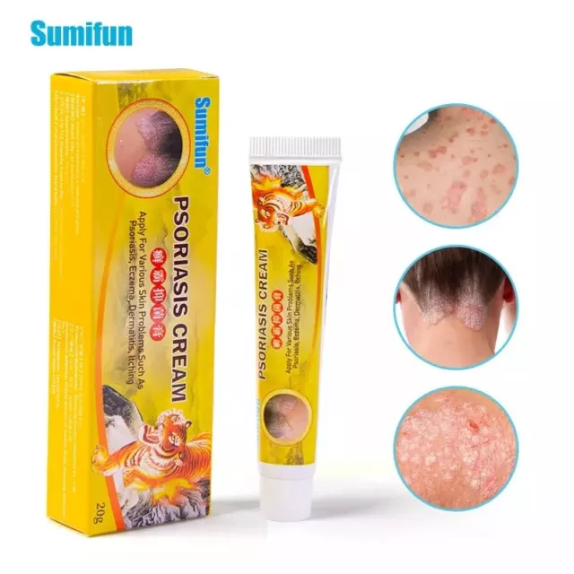 Effective Sumifun Tiger Balm cream for Psoriasis, Eczema, Itching skin - UK