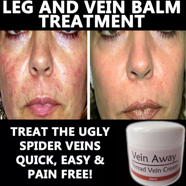 Vein Away Creme Lotion Entfernen Fadenvenen Besenreiser Gesicht Und Körper