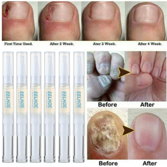 NAIL REPAIR ANTI Fungal Nail Infection Onychomycosis Paronychia