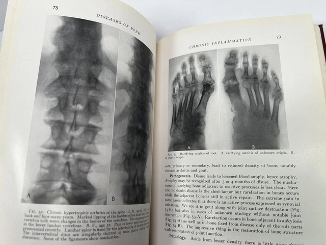 1931 Surgical Pathology Arthur Hertzler antique medical book oddity disease bone