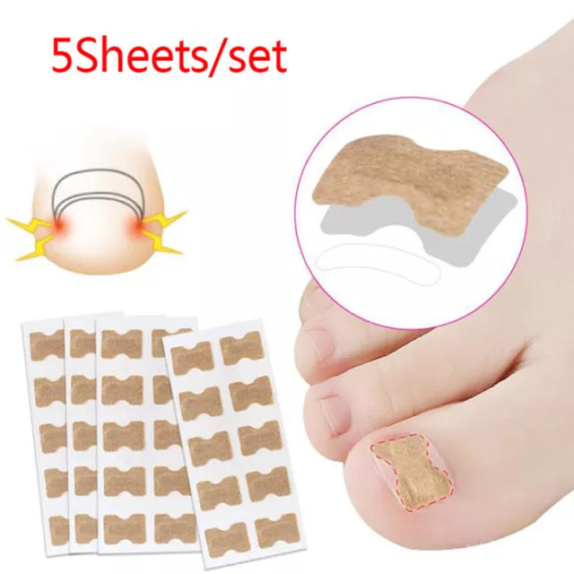 5 Sheets Ingrown Toenail Concealer Stickers Paronychia Treatment Recover TR1EL