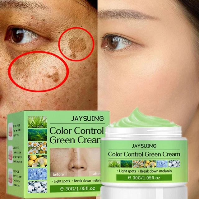 rimuovere melasma rimozione lentiggini crema schiarente melanina