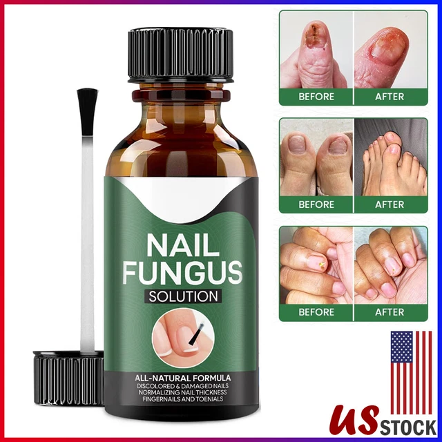 ANTI FUNGAL TREATMENT Extra Strength Toenail Fungus Fungi Xs Nail
