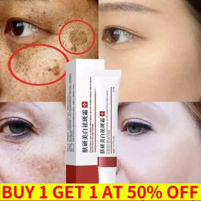 Freckle Cream Strong Remove Dark Spot Fade Acne Scars Melanin Pigment Melasma ~