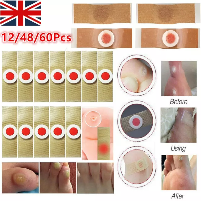 60X Corn Removal Patch Toe Callus Corn Remover Pads Wart Treatment Patch Foot UK