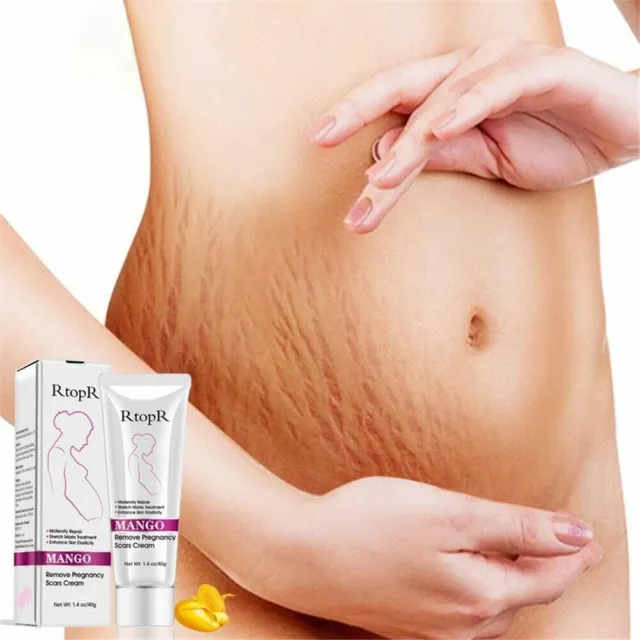 ⭐️⭐️⭐️⭐️⭐️ Firming, belly-reducing stretch marks or pregnancy stretch marks
