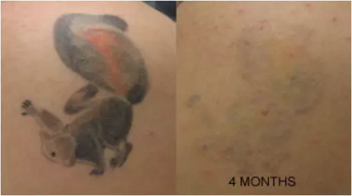 Spartan Perform Tattoo Destroyer All Natural Removal Fading System 12 Month 2