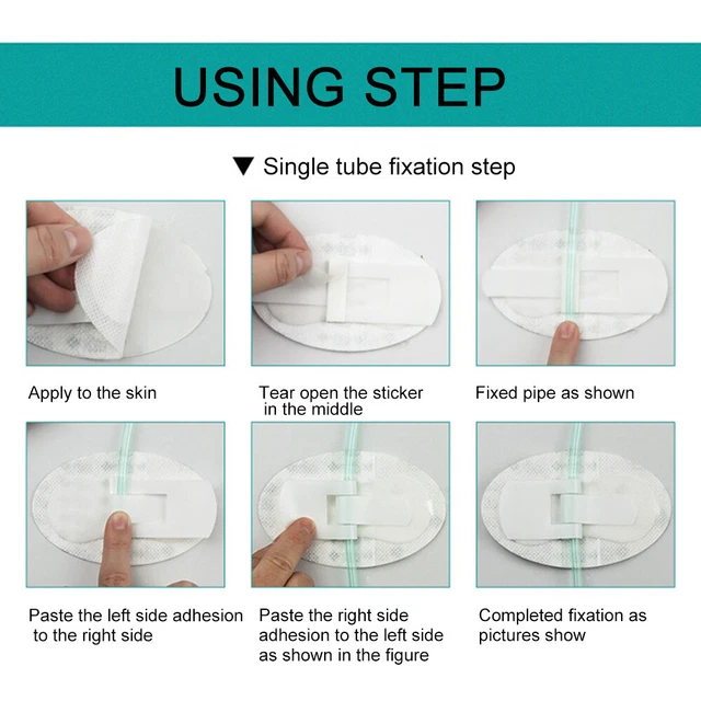 Halter Für Stabilisierungsgeräte Für Körperoberflächenkatheter Feste Paste
