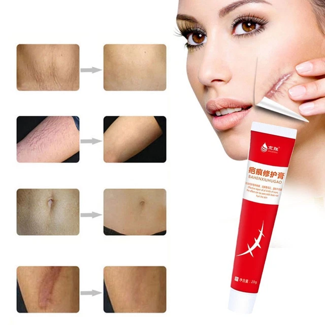 Crema de reparación de cicatrices de pigmentación gel quemaduras cicatrices estirantes cicatrices cicatrices