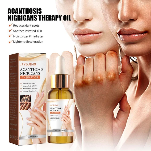 50 ml spray terapia acantocleare, olio terapia acanthosis nigricans