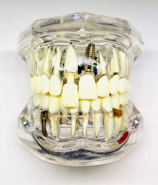 Dental Teeth Model Teach Study Teaching Implant Adult Analysis Demonstration 2