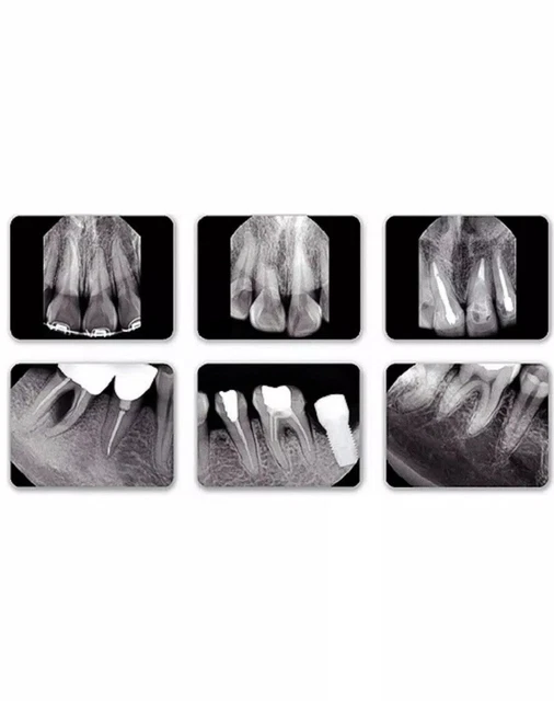 Dental Xray Sensor Size 1.5 Twain Driver Compatible x ray digital