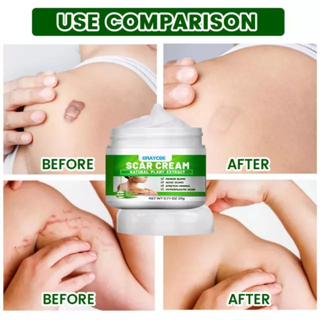 Acne Scar Spots Removal Cream Burns Stretch Marks Repair Treatment Gel W2C4