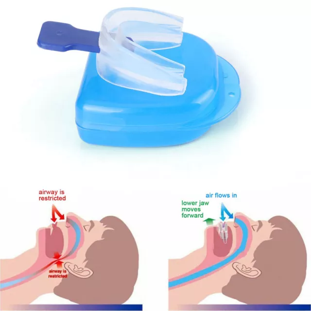 1 Piezas Dejar De Roncar Boquilla Guardia Anti Ronquido Sueño Dientes Molienda