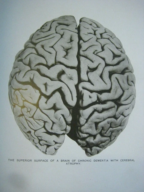 Rare ✅ Gross Morbid Anatomy_Insane Brains_ 75 Large Pictures_Antique Doctor Book