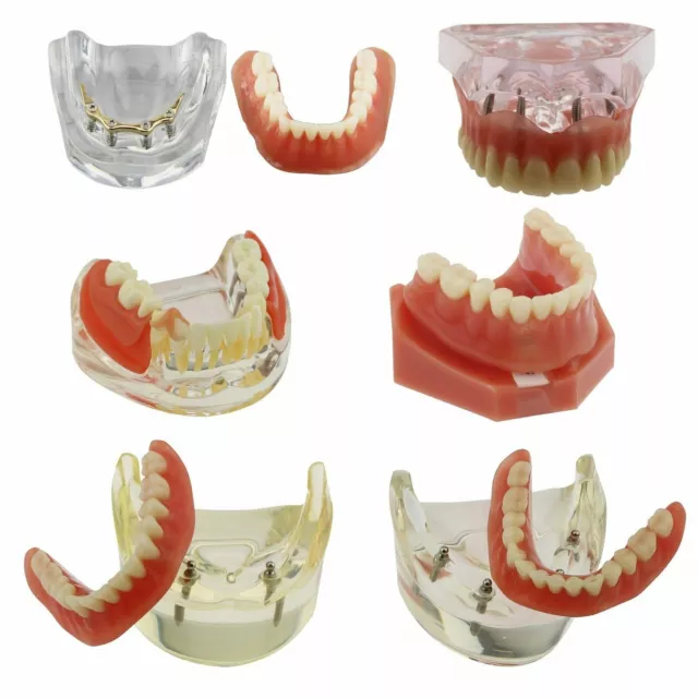 6 Type Dental Implants Restoration Overdenture Inferior Golden Study Demo Model