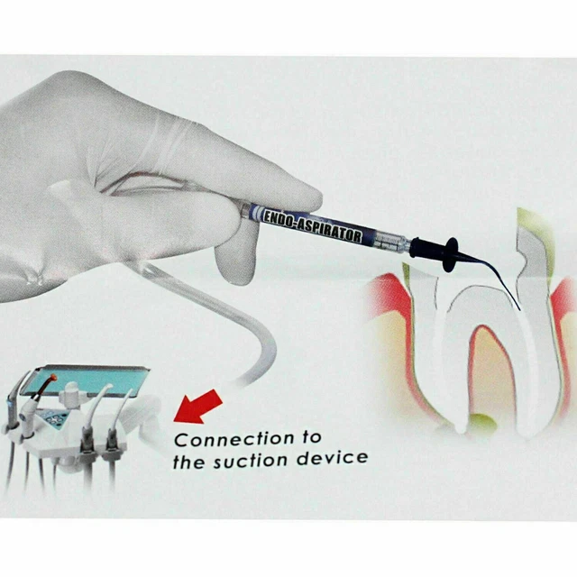 Traitement endodontique du canal radiculaire Endo-Aspirator Dental...