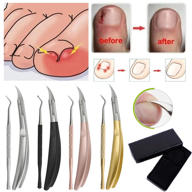 Kit Soin Des Ongles Incarnés - 7 Outils En Acier Inoxydable, Manche Antidérapant - Neuf