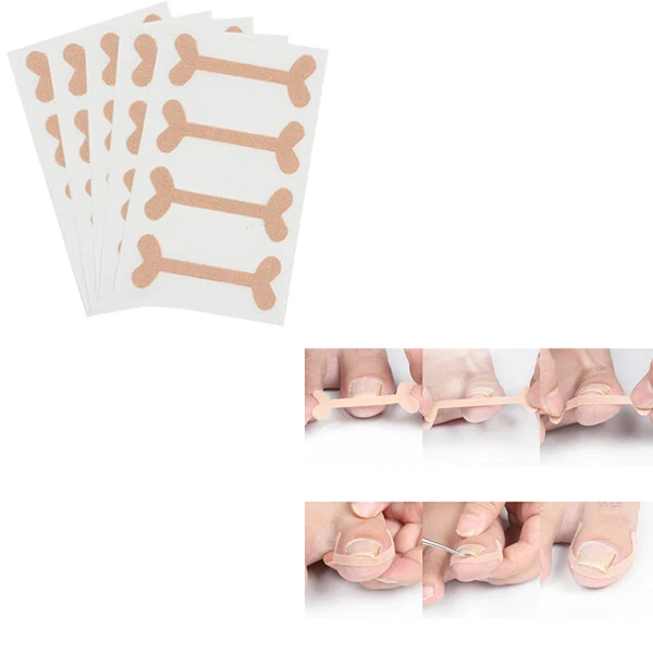 Paronichia 4 Piezas Uñas Encarnadas Parches De Correctivas Adhesivo Pies Algodón