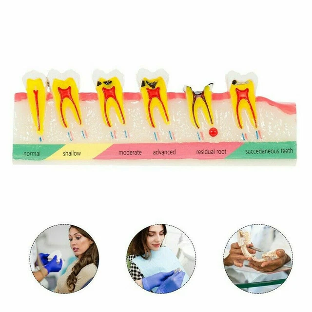 DENTAL CARIES MODEL Tooth Decay Dental Periodontitis Model Dental ...