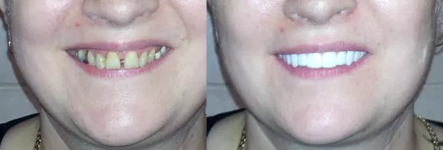 Imako Denti Cosmetici, Sorriso, Faccette, Sbiancati, Naturali 3