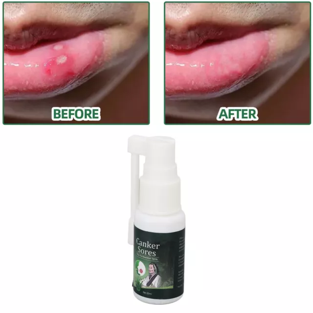 Canker Sore Relief Spray Men Women Herbal Extract Mouth Sore Relief Spray UK