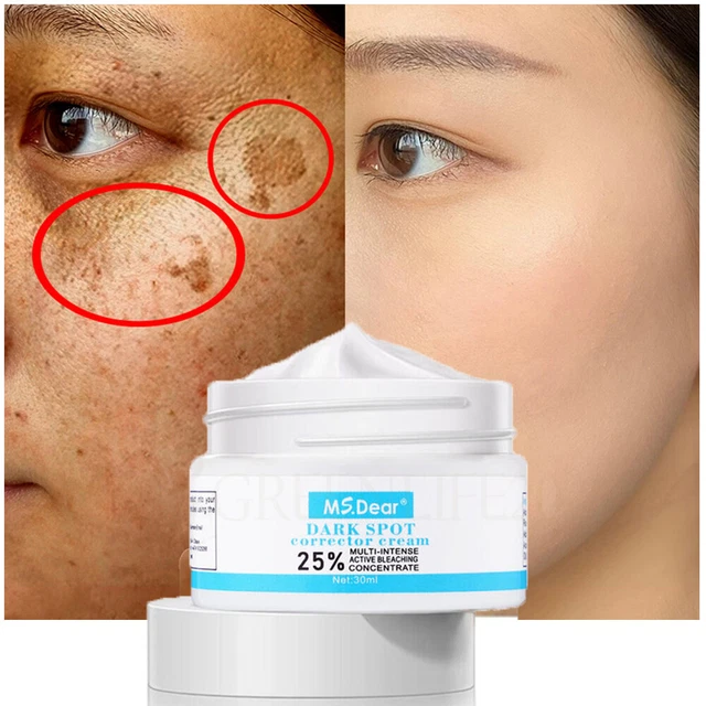 Crema sbiancante melasma forte rimozione lentiggini macchie brufoli melano