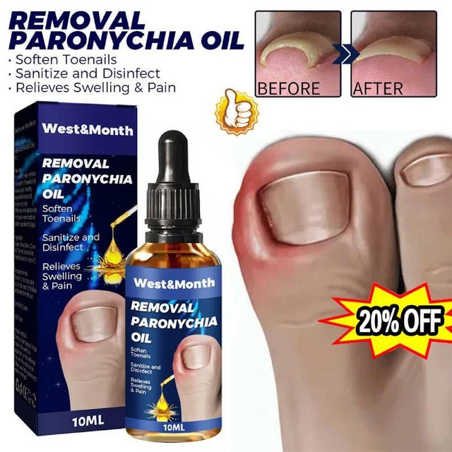 ANTI PARONYCHIA TREATMENT ExtraStrength Toenail Fungus Athletes Foot