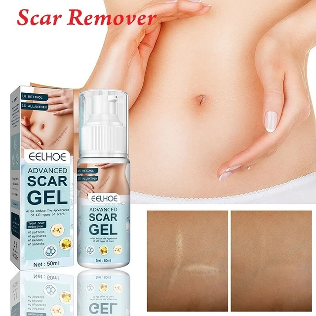 Eliminación de cicatrices cicatrices quirúrgicas estrías estrías granos mancha gel para cuidado de la piel belleza