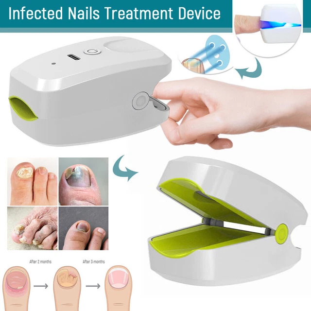 905NM NEW POWERFUL Nail Fungus Treatment Cold Lazer Therapy ...