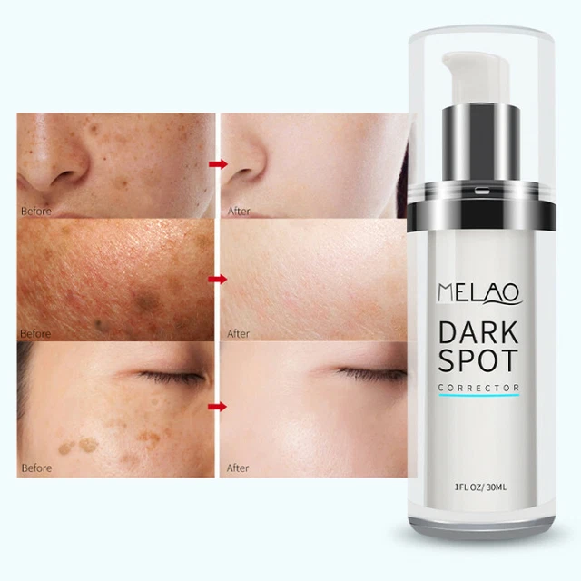 2 HYDROQUINONE DARK Spot Corrector Remover Face & Melasma Treatment