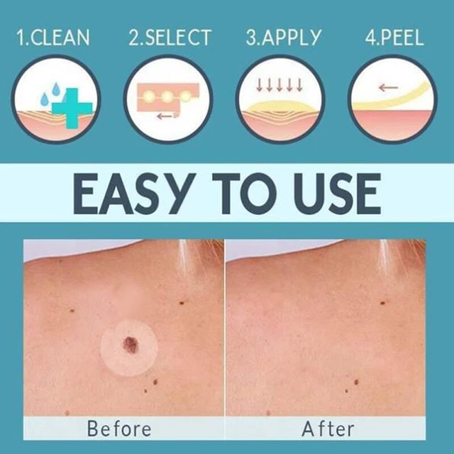 1/3pcs Skin Moles Acne Removal Patch Pimple Remover Tool Blemish Spot Skin Ca ql