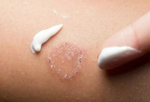 Tratamiento de la sarna creóbica crema cura para la piel tiña parásitos antifúngicos GRATIS