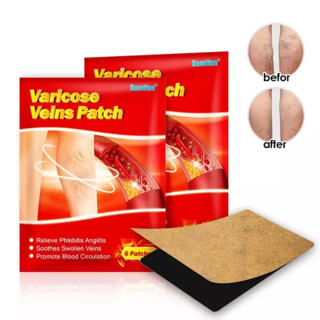 12x Varices Veines Plâtre Angiitis Retrait À Base de Plantes Patchs