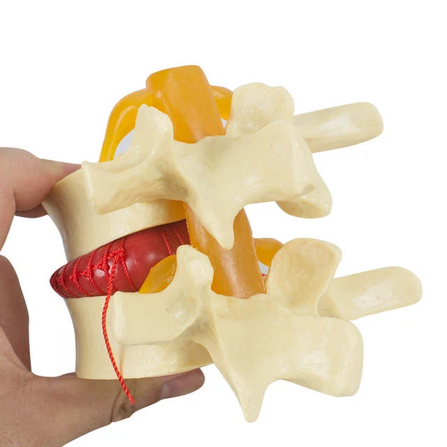 11.5 SPINE LUMBAR Disc Herniation Model For Medical and Biology lab