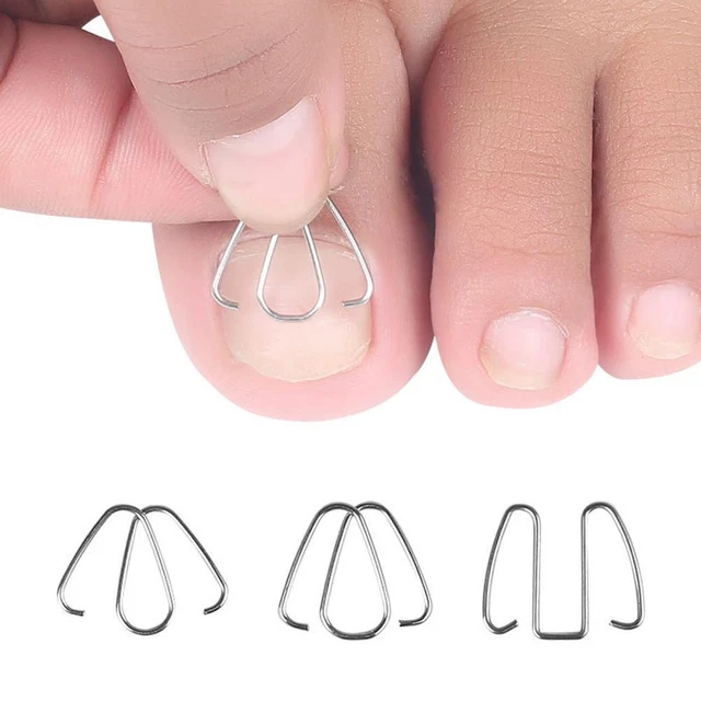 INGROWN TOE NAIL Correction Hook/Rubber Band Paronychia Orthosis